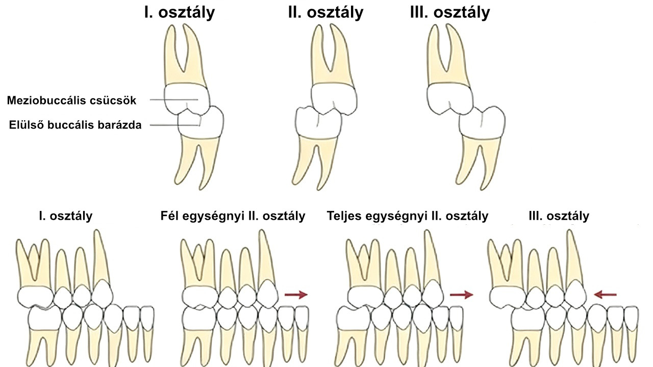 kutya fogazat Angle féle osztályozás
