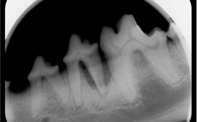 röntgenfelvételen látható az állkapocscsont oldódása is